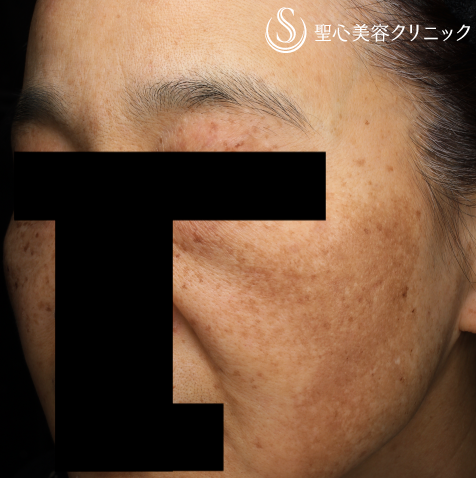 【50代女性・広範囲の肝斑を改善】トラネキサム酸錠（トランサミン酸錠）_シミ＋infact® ビューティーエナジーPQQプラス（医師監修のビタミンサプリメント）_美白・美肌（1ヶ月後） Before 