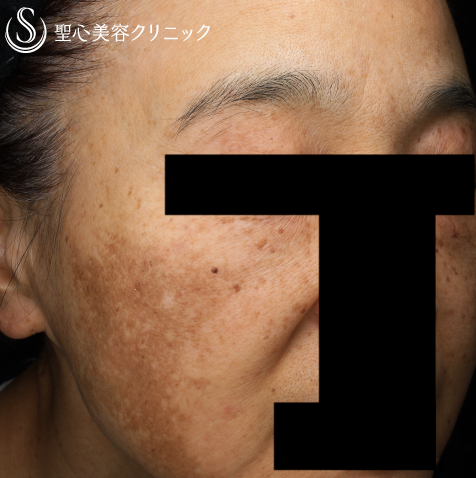 【50代女性・広範囲の肝斑を改善】トラネキサム酸錠（トランサミン酸錠）_シミ＋infact® ビューティーエナジーPQQプラス（医師監修のビタミンサプリメント）_美白・美肌（1ヶ月後） Before 