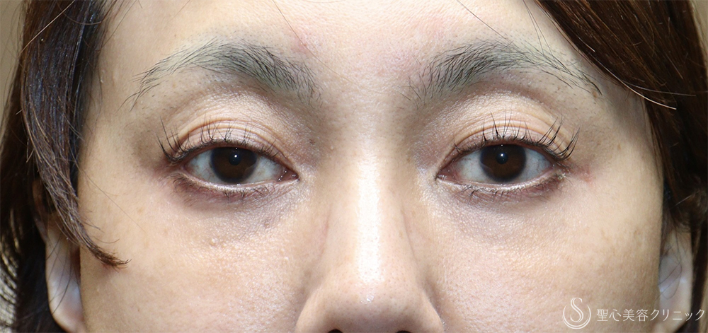 【40代女性・目の上のくぼみ】眼瞼下垂（切開法/腱膜縫縮法）（1週間後） Before 