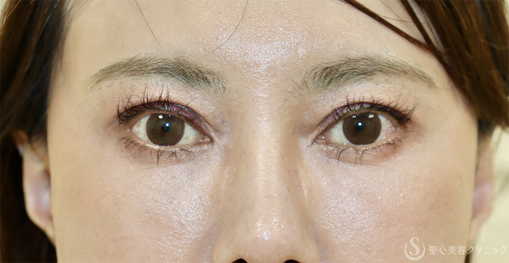 【40代女性・目の上のくぼみ】眼瞼下垂（切開法/腱膜縫縮法）（1週間後） After 