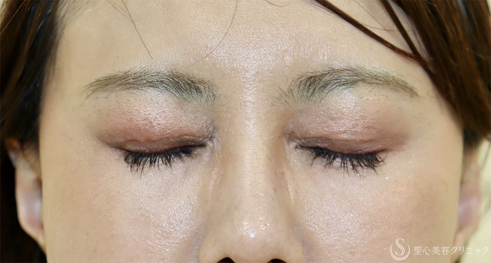 【40代女性・目の上のくぼみ】眼瞼下垂（切開法/腱膜縫縮法）（1週間後） After 