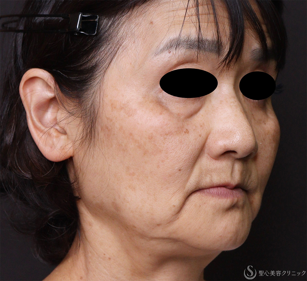 【60代女性・顔のたるみ改善】フェイスリフト（術後3日後～2ヶ月後） Before 