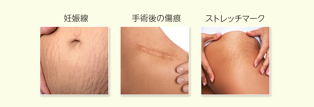 スキンリジュビネーションの適応