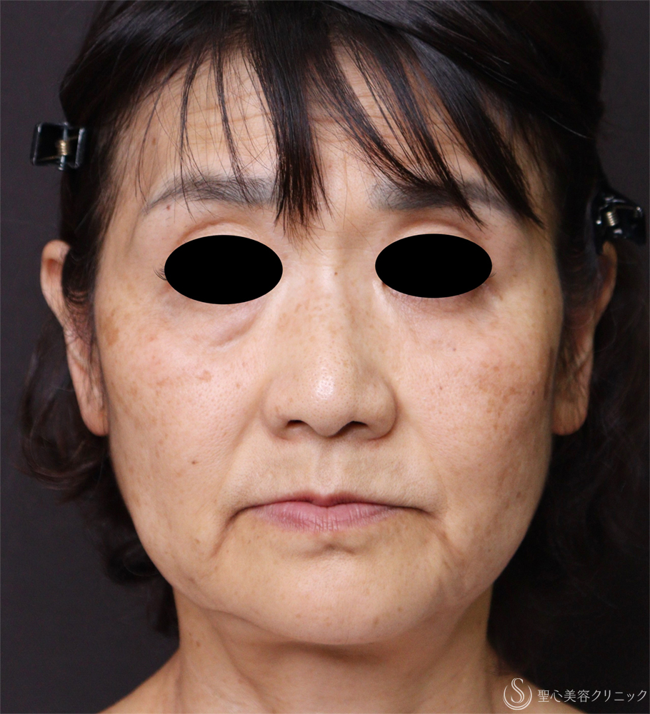 【60代女性・顔のたるみ改善】フェイスリフト（術後3日後～2ヶ月後） Before 