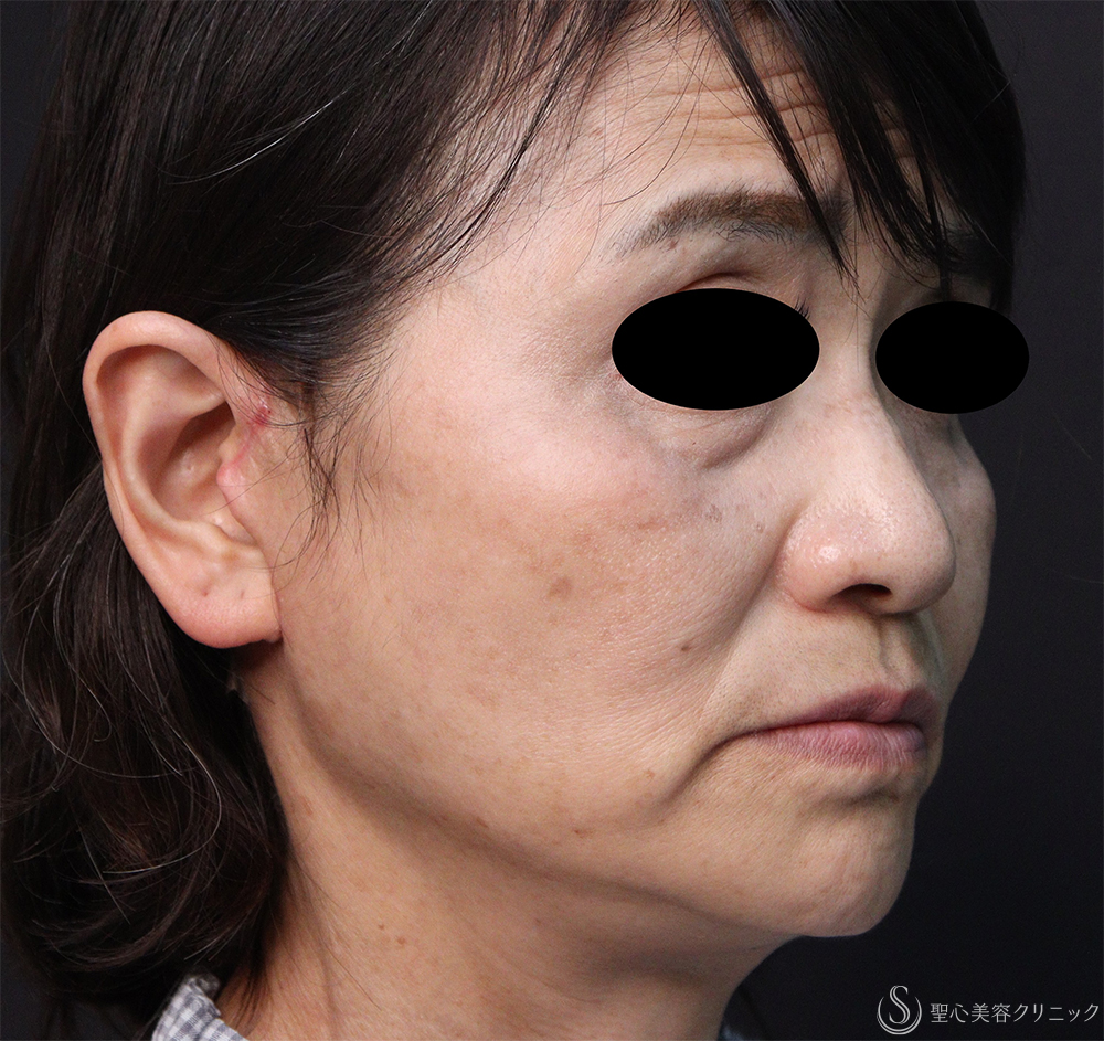 【60代女性・顔のたるみ改善】フェイスリフト（術後3日後～2ヶ月後） After 