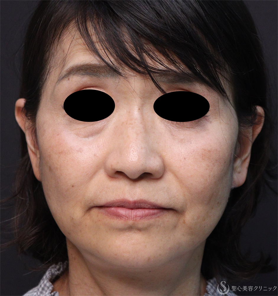 【60代女性・顔のたるみ改善】フェイスリフト（術後3日後～2ヶ月後） After 