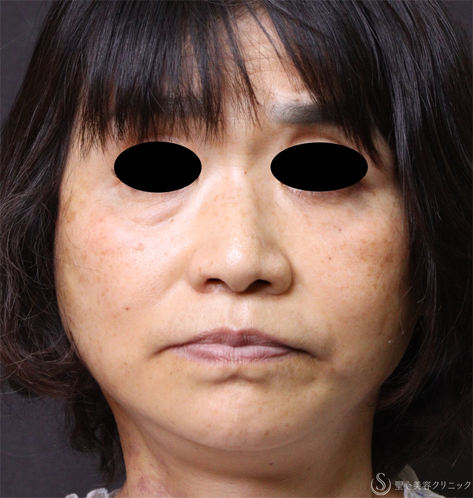 【60代女性・顔のたるみ改善】フェイスリフト（術後3日後～2ヶ月後） After 