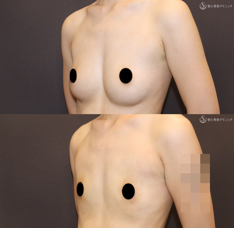 【20代女性・男性らしい胸を作る】乳房切除（2ヶ月後） After 