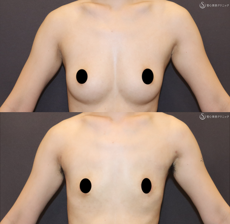 【20代女性・男性らしい胸を作る】乳房切除（2ヶ月後） After 