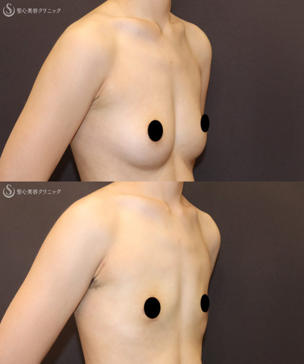 【20代女性・男性らしい胸を作る】乳房切除（2ヶ月後） After 