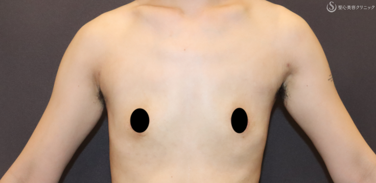 【20代女性・男性らしい胸を作る】乳房切除（2ヶ月後） After 