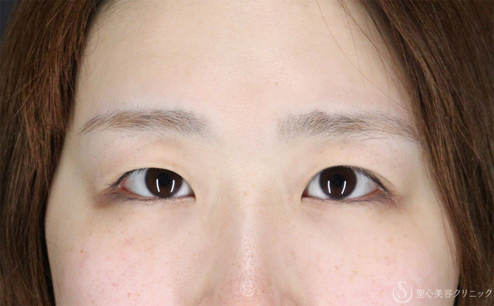 【20代女性・切開法で華やか二重】二重術（切開法）部分切開／全切開（8ヶ月後） Before 