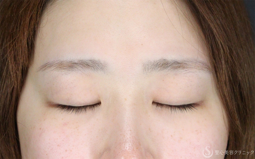 【20代女性・切開法で華やか二重】二重術（切開法）部分切開／全切開（8ヶ月後） Before 