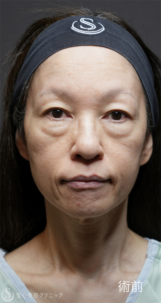 【50代女性・目の下のクマ治療で劇的な若返り】下眼瞼切開術/下眼瞼除皺術/ハムラ法＋ミッドチークリフト（1ヶ月後） Before 