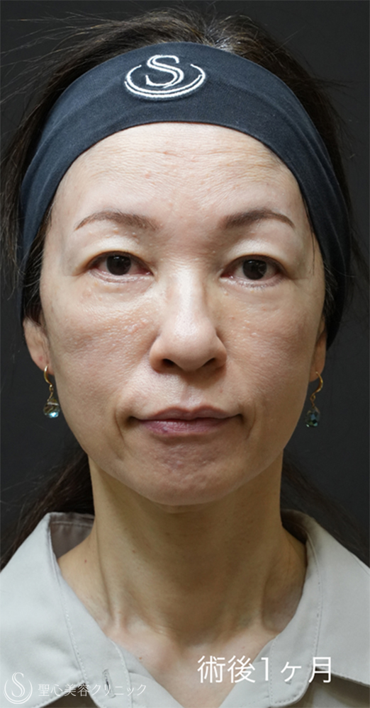 【50代女性・目の下のクマ治療で劇的な若返り】下眼瞼切開術/下眼瞼除皺術/ハムラ法＋ミッドチークリフト（1ヶ月後） After 