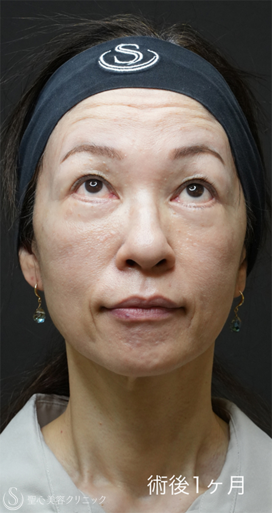 【50代女性・目の下のクマ治療で劇的な若返り】下眼瞼切開術/下眼瞼除皺術/ハムラ法＋ミッドチークリフト（1ヶ月後） After 