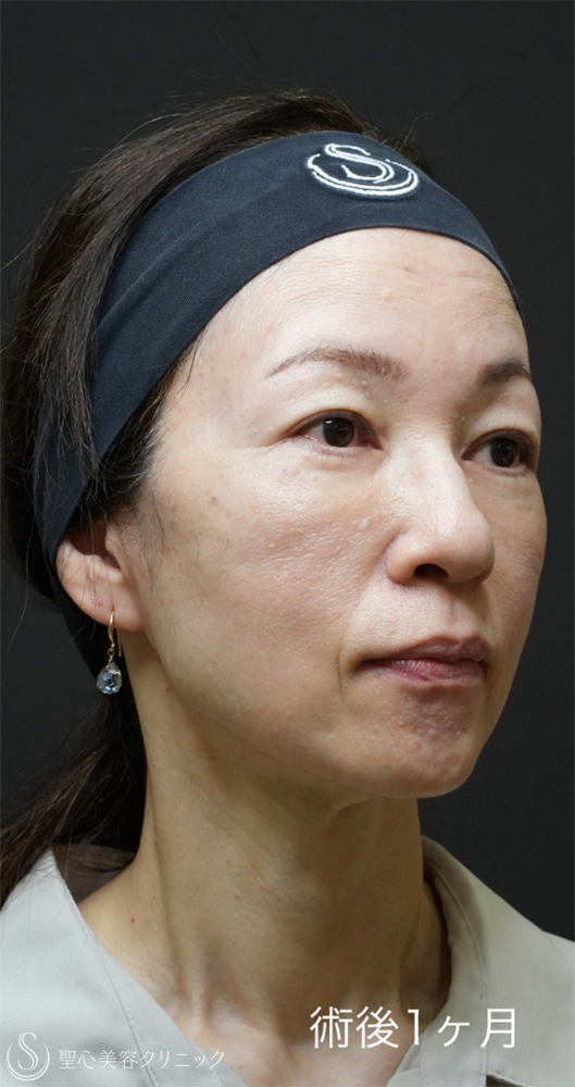 【50代女性・目の下のクマ治療で劇的な若返り】下眼瞼切開術/下眼瞼除皺術/ハムラ法＋ミッドチークリフト（1ヶ月後） After 