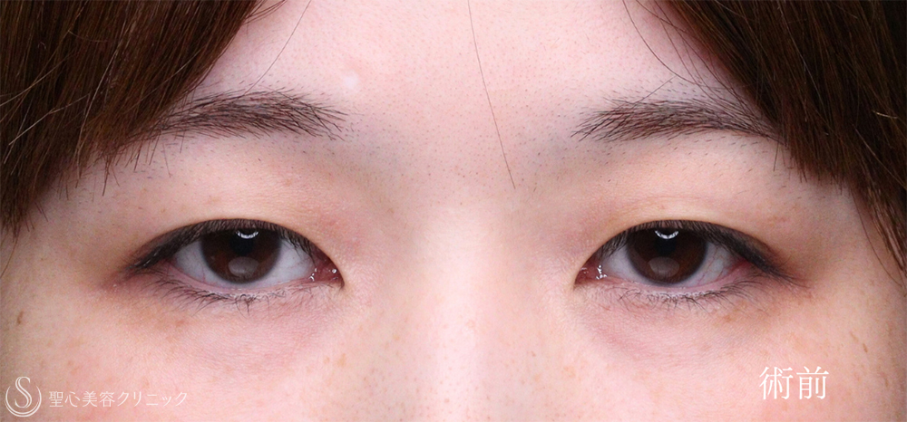 【30代女性・眼瞼下垂手術で目の開きを自然に改善】眼瞼下垂（切開法/腱膜縫縮法）（1週間後） Before 