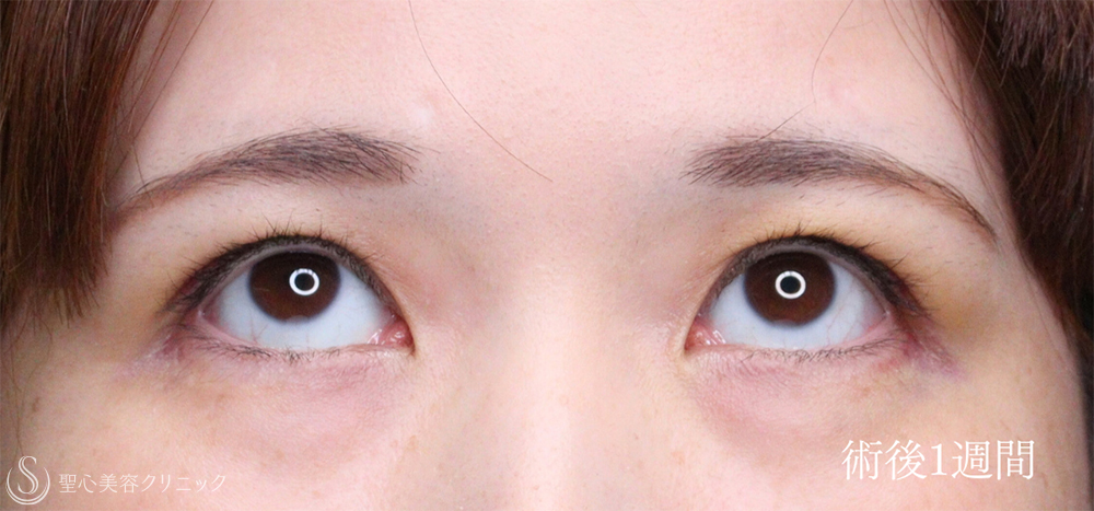 【30代女性・眼瞼下垂手術で目の開きを自然に改善】眼瞼下垂（切開法/腱膜縫縮法）（1週間後） After 