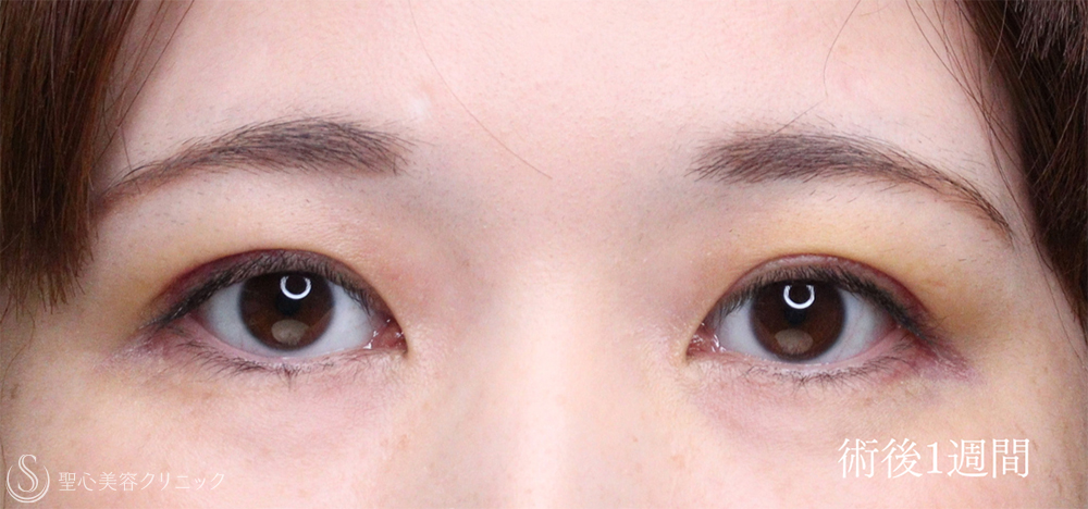【30代女性・眼瞼下垂手術で目の開きを自然に改善】眼瞼下垂（切開法/腱膜縫縮法）（1週間後） After 