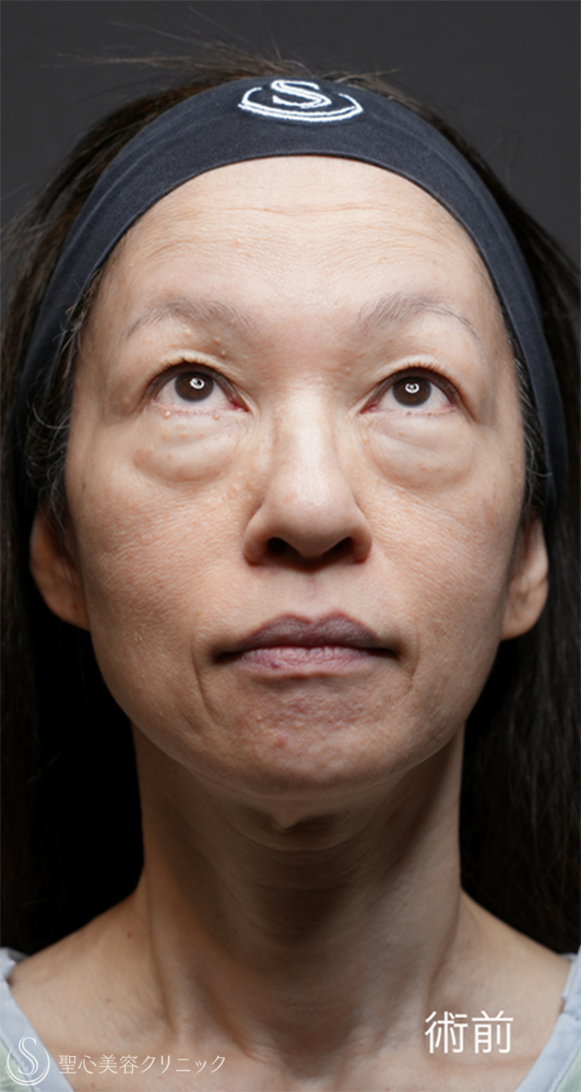 【50代女性・目の下のクマ治療で劇的な若返り】下眼瞼切開術/下眼瞼除皺術/ハムラ法＋ミッドチークリフト（1ヶ月後） Before 