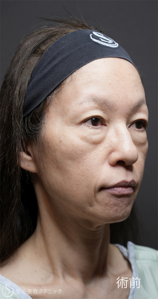【50代女性・目の下のクマ治療で劇的な若返り】下眼瞼切開術/下眼瞼除皺術/ハムラ法＋ミッドチークリフト（1ヶ月後） Before 