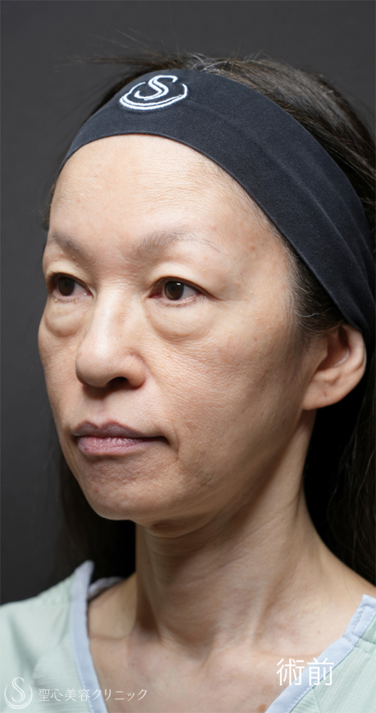 【50代女性・目の下のクマ治療で劇的な若返り】下眼瞼切開術/下眼瞼除皺術/ハムラ法＋ミッドチークリフト（1ヶ月後） Before 