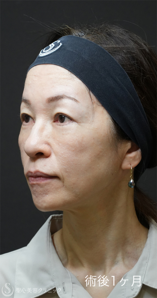 【50代女性・目の下のクマ治療で劇的な若返り】下眼瞼切開術/下眼瞼除皺術/ハムラ法＋ミッドチークリフト（1ヶ月後） After 