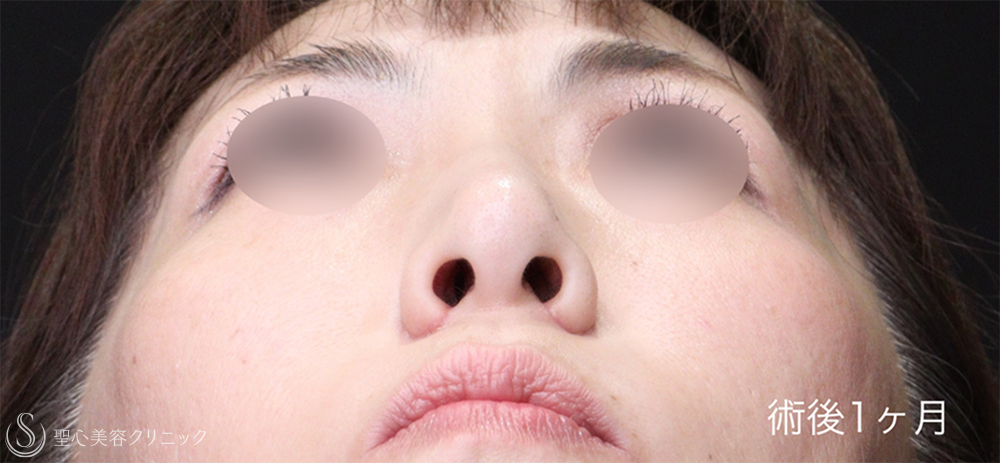 【50代女性・小鼻縮小で自然な忘れ鼻に】 小鼻縮小（1ヶ月後） After 