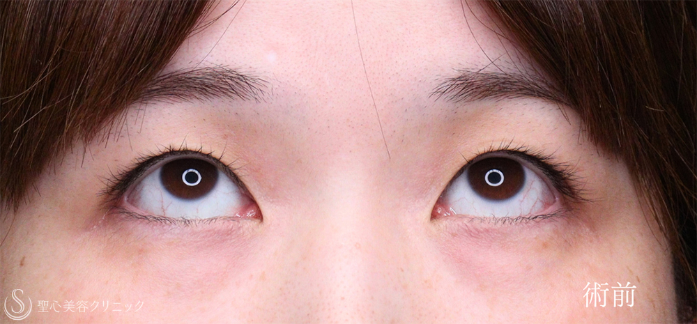 【30代女性・眼瞼下垂手術で目の開きを自然に改善】眼瞼下垂（切開法/腱膜縫縮法）（1週間後） Before 