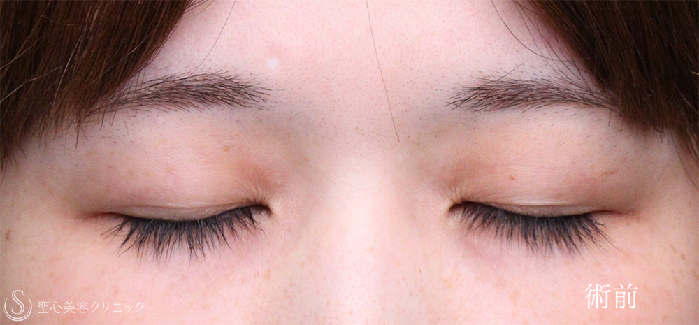 【30代女性・眼瞼下垂手術で目の開きを自然に改善】眼瞼下垂（切開法/腱膜縫縮法）（1週間後） Before 