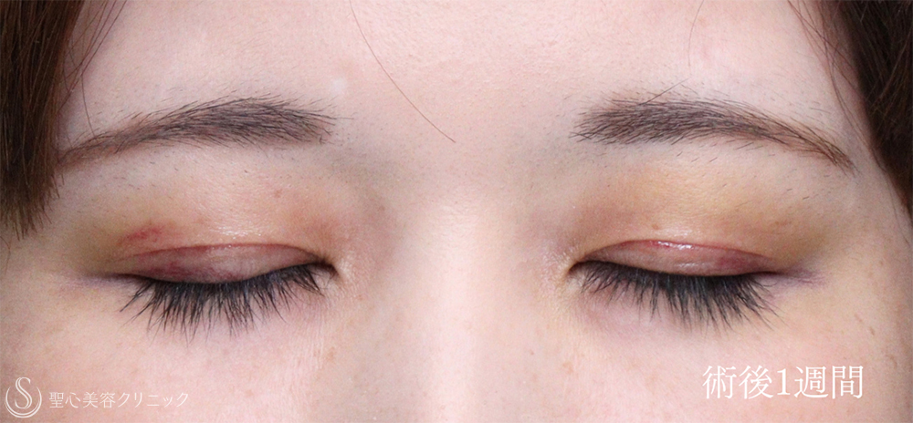 【30代女性・眼瞼下垂手術で目の開きを自然に改善】眼瞼下垂（切開法/腱膜縫縮法）（1週間後） After 