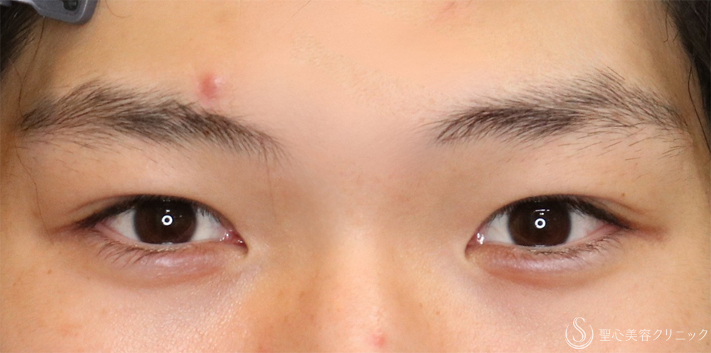 【20代男性・自然に目力アップ】目頭切開/目上切開（1ヶ月後） Before 名古屋+目上切開・目頭切開・二重