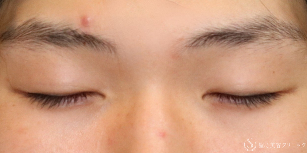 【20代男性・自然に目力アップ】目頭切開/目上切開（1ヶ月後） Before 名古屋+目上切開・目頭切開・二重