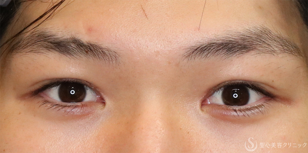 【20代男性・自然に目力アップ】目頭切開/目上切開（1ヶ月後） After 名古屋+目上切開・目頭切開・二重