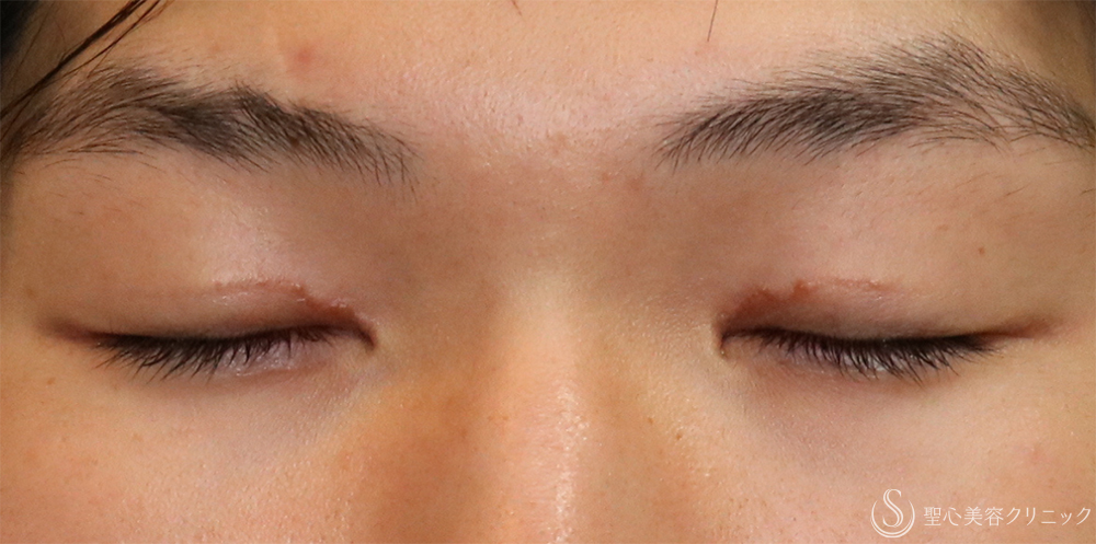 【20代男性・自然に目力アップ】目頭切開/目上切開（1ヶ月後） After 名古屋+目上切開・目頭切開・二重