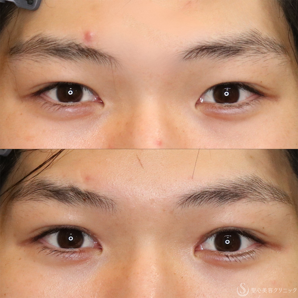 【20代男性・自然に目力アップ】目頭切開/目上切開（1ヶ月後） After 名古屋+目上切開・目頭切開・二重