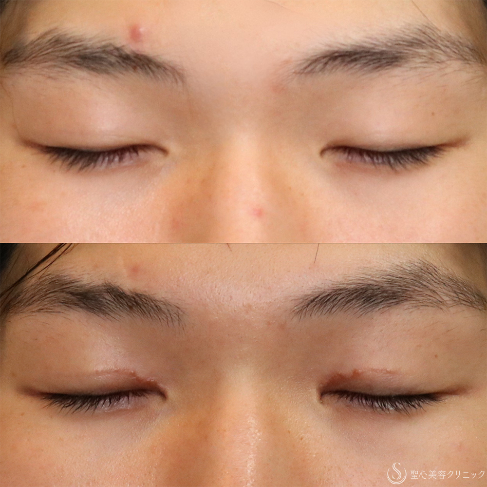 【20代男性・自然に目力アップ】目頭切開/目上切開（1ヶ月後） After 名古屋+目上切開・目頭切開・二重
