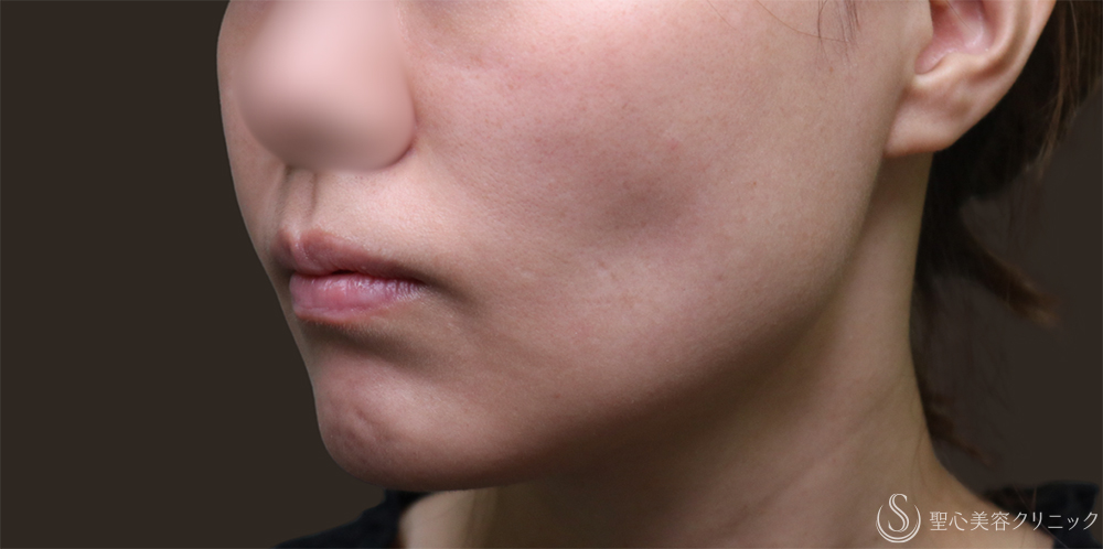 【30代女性・他院脂肪吸引後の補正】プレミアムPRP皮膚再生療法（1年4ヶ月後） Before 他院修正・頬の凹み・頬コケ