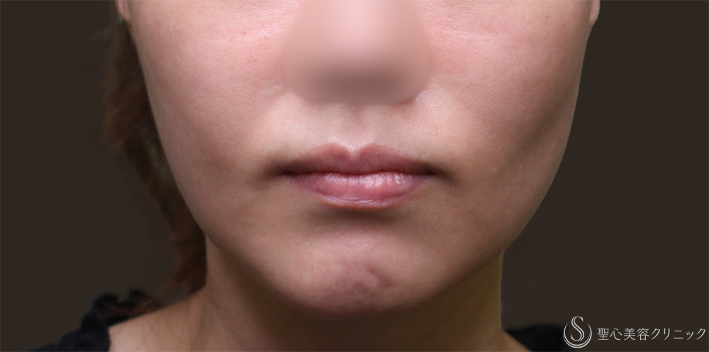 【30代女性・他院脂肪吸引後の補正】プレミアムPRP皮膚再生療法（1年4ヶ月後） Before 他院修正・頬の凹み・頬コケ