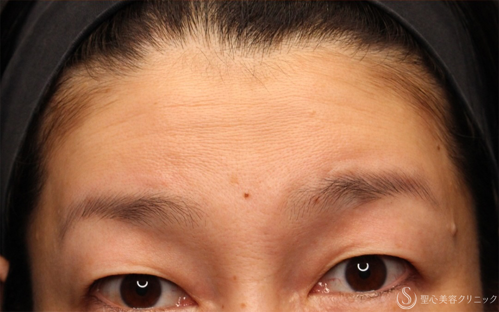 【40代女性・眉上げのしわ改善】プレミアムPRP皮膚再生療法（10ヶ月後） After 