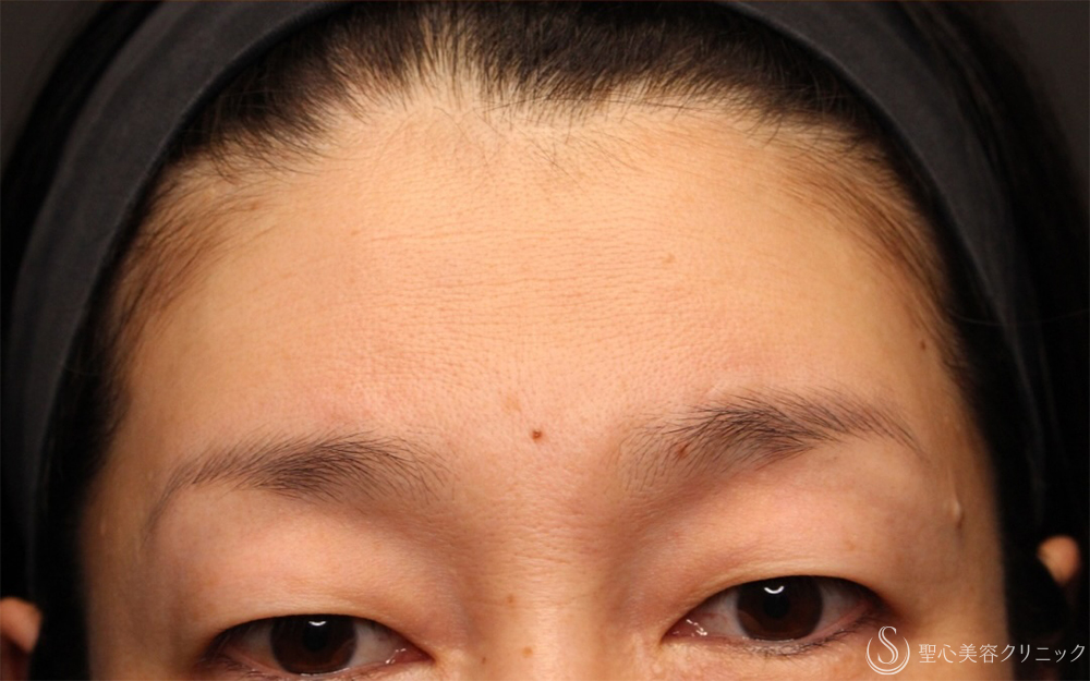 【40代女性・眉上げのしわ改善】プレミアムPRP皮膚再生療法（10ヶ月後） After 
