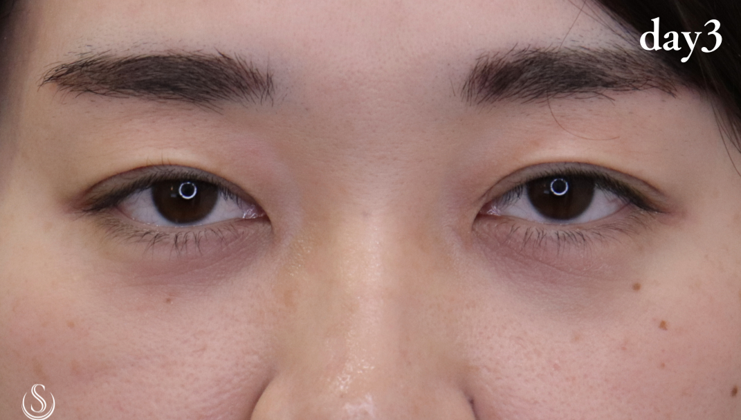 【20代女性・気になるまぶたの左右差を解消】二重術（埋没法）：マイクロメソッド+α（90日後） After 