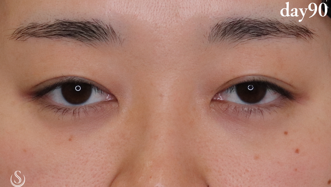 【20代女性・気になるまぶたの左右差を解消】二重術（埋没法）：マイクロメソッド+α（90日後） After 
