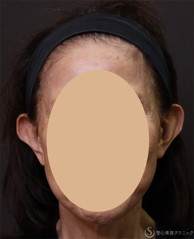 【70代女性・耳の形をきれいに】立ち耳（埋没法）（1ヶ月後） Before 