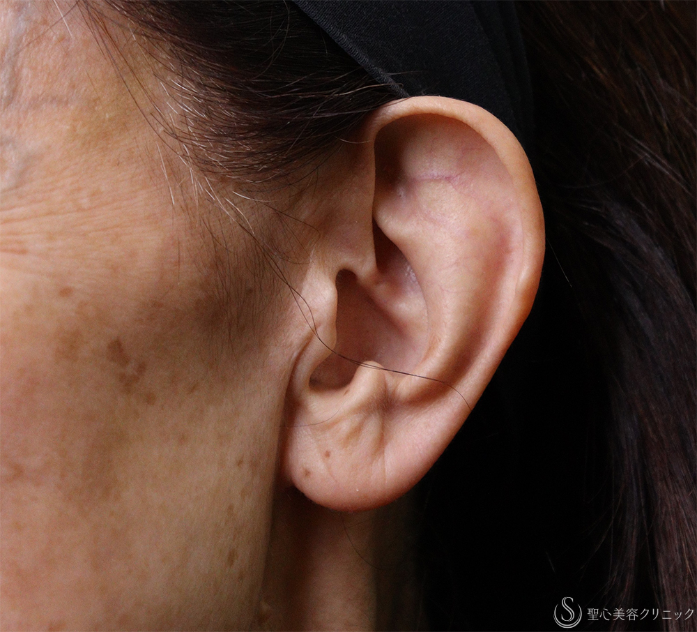 【70代女性・耳の形をきれいに】立ち耳（埋没法）（1ヶ月後） Before 