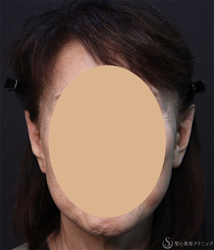 【70代女性・耳の形をきれいに】立ち耳（埋没法）（1ヶ月後） After 