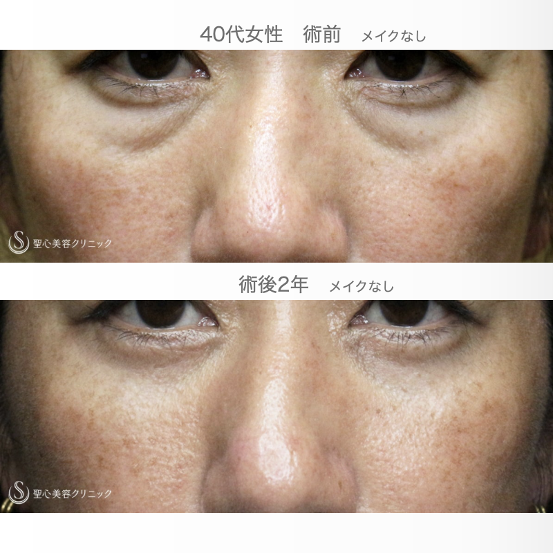【40代女性・目の下のクマ＆タルミ】表ハムラ+α法「Ver.2」単独（術直後〜2年後） After 