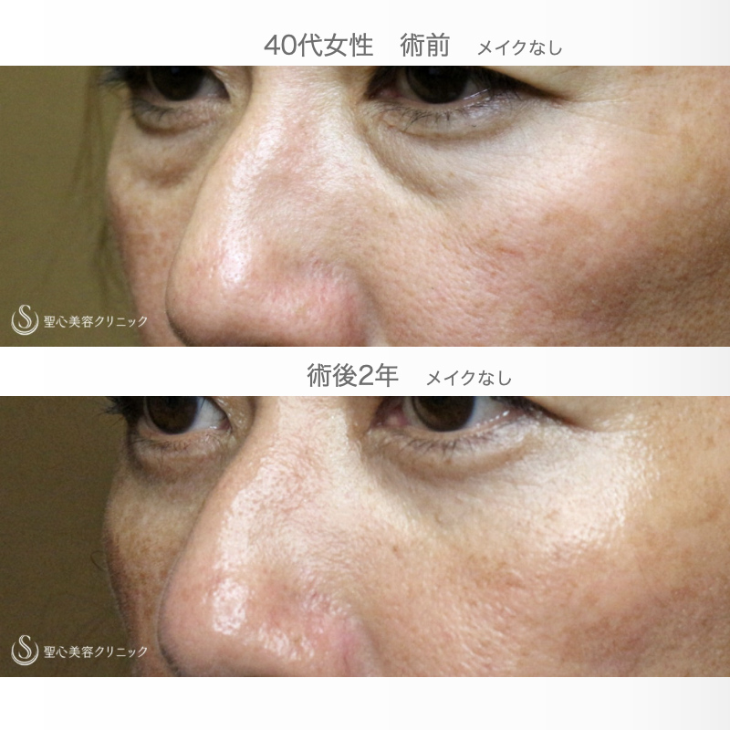 【40代女性・目の下のクマ＆タルミ】表ハムラ+α法「Ver.2」単独（術直後〜2年後） After 