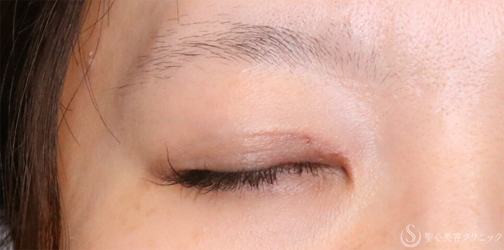 【30代女性・理想の平行二重に】目頭切開/目上切開（1ヶ月後） After 名古屋・目頭切開